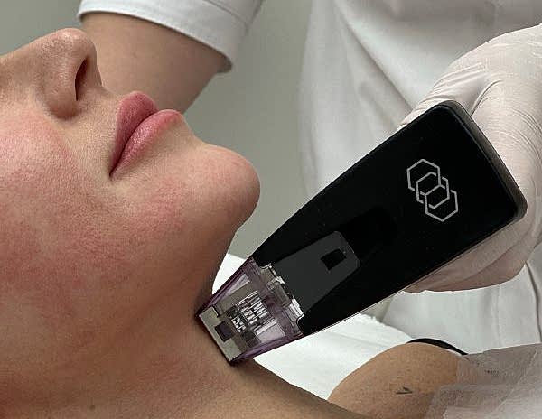 Микроигольчатый RF-лифтинг Morpheus 8