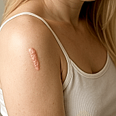 Удаление келоидных рубцов