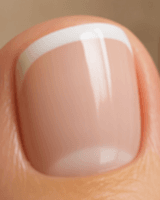 Коррекция вросших ногтей