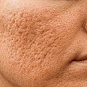 Субцизия рубцов