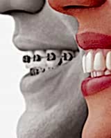 Ортодонтия (исправление прикуса)