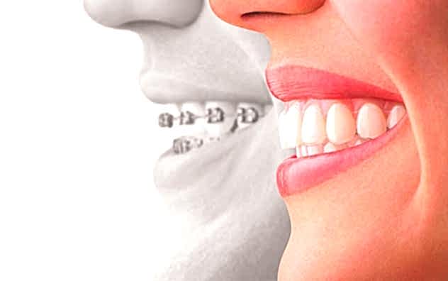 Ортодонтия (исправление прикуса)