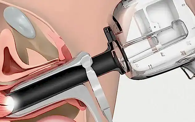 Кольпоскопия